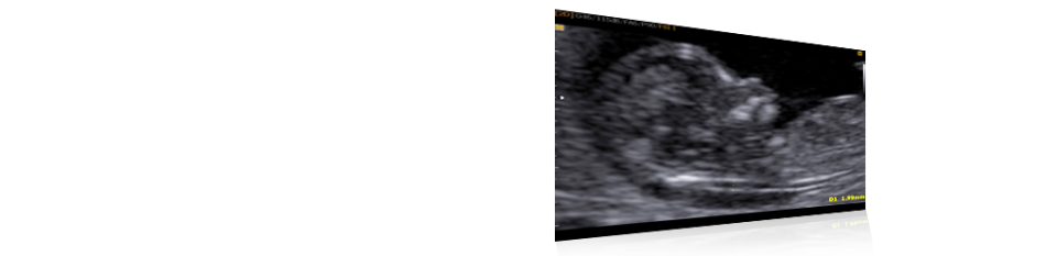 Jak přesná je datování ultrazvuku