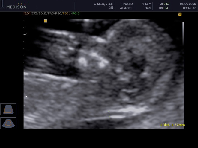 ultrazvukové vyšetření datování těhotenství